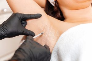 Cosmetologist in black latex gloves makes injection of botulinum toxin on the woman's axillary hollows against hyperhidrosis. Armpit with white drawn grid. Close up.